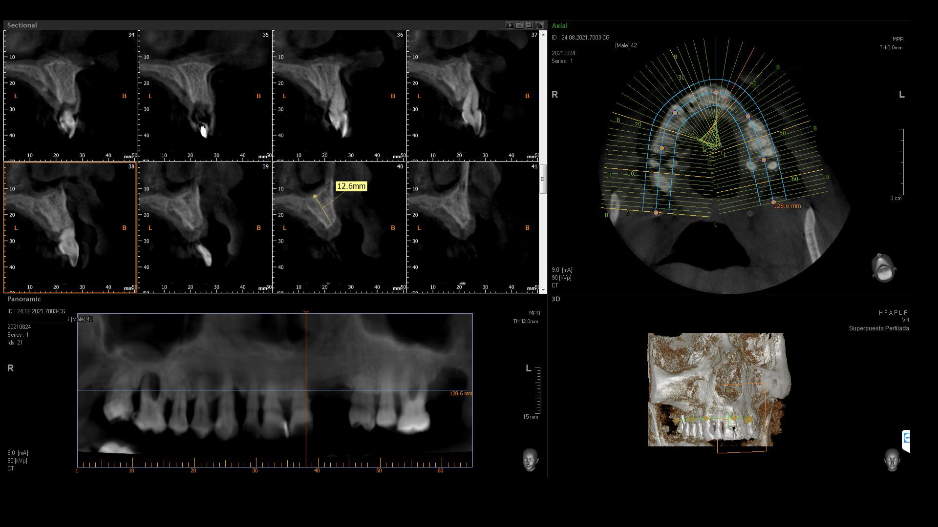 que es la cirugía guiada de implantes