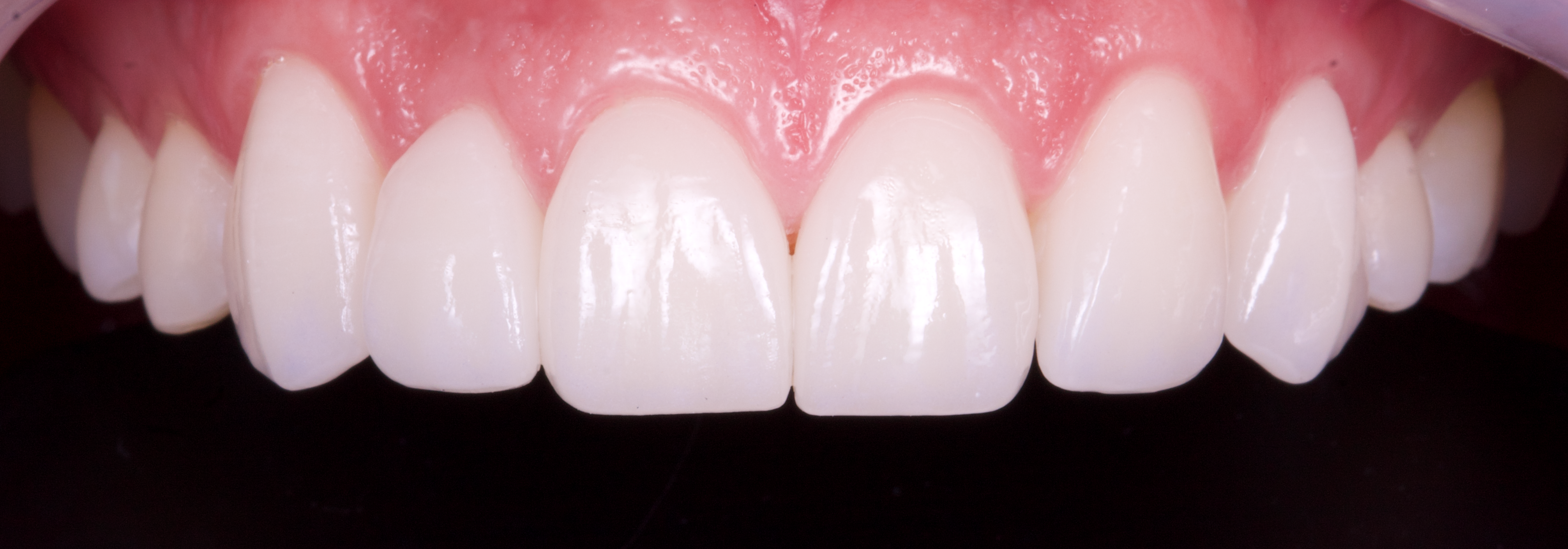 blanqueamiento dental